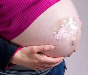孕妇患上白癜风有哪些危害