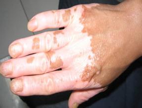 手部白斑扩散常见的问题是什么