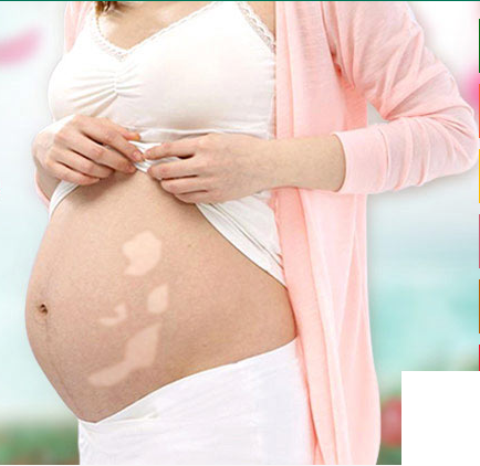 女性怀孕期间白斑的症状表现?